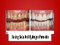 /e65a7fded6-3-proven-teeth-stain-home-remedies