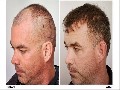 /a59392e633-the-forhair-clinic-fue-hair-transplant