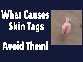Know The Reason For Skin Tags And Avoid Them